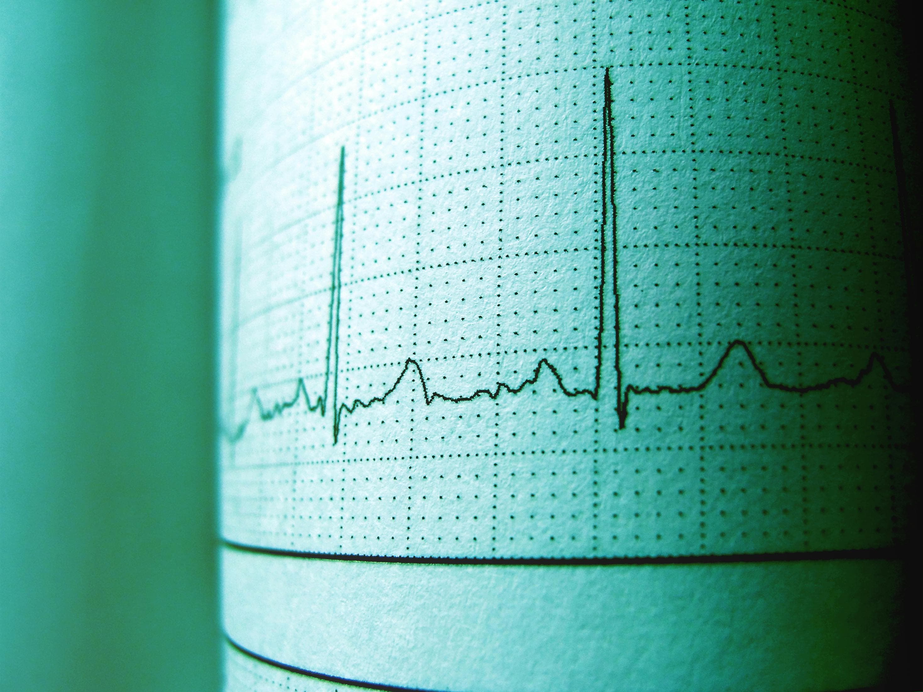 Understanding Each Small Box on an ECG: A Comprehensive Guide | Harmony ...